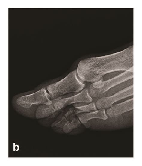 Magnified Anteroposterior A And Lateral Oblique B Radiographs Of