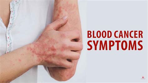 Blood cancer symptoms - Blood Cancer Sri Lanka