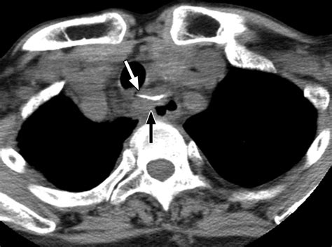 Esophagography After Pneumomediastinum Without Ct Findings Of