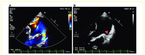 Echocardiography showing patent ductus arteriosus and left pulmonary... | Download Scientific ...