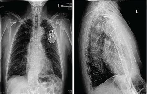 Aortic Stenosis X Ray