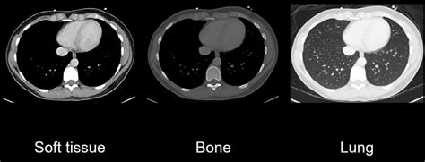 Abdominal Ct Windows Basics • Litfl • Radiology Library