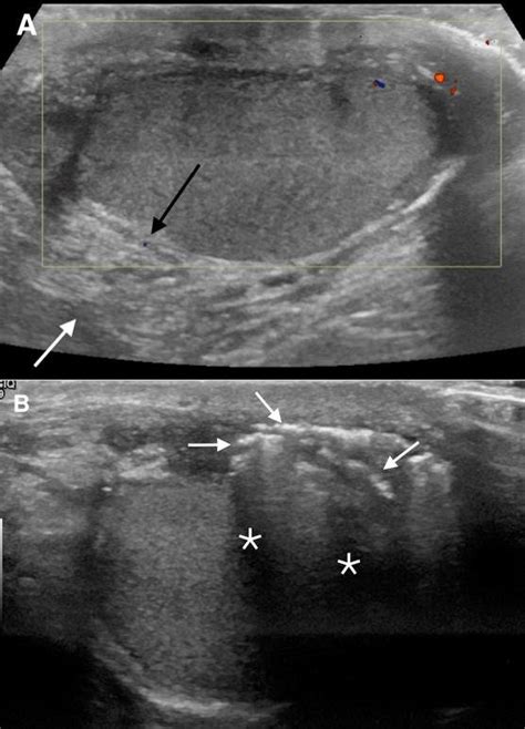 35-year-old man with left scrotal pain and swelling. FINDINGS:... | Download Scientific Diagram