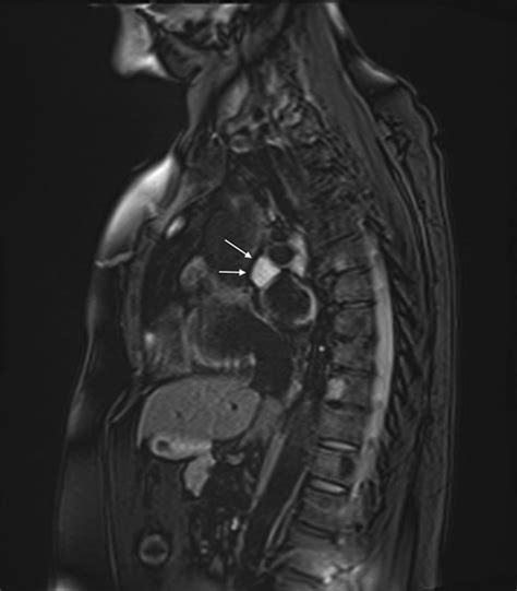 Cardiac Paraganglioma Circulation Cardiovascular Interventions