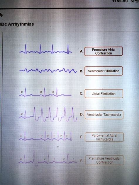 Solved 1152 903f Cardiac Arrhythmias Premature Atrial Contraction