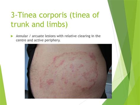 Infective Dermatoses ——fungal Infections Ppt Download