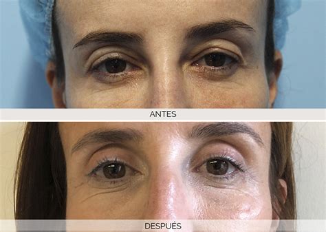 Blefaroplastia o cirugía de párpados