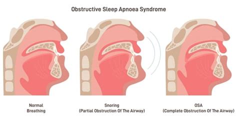 Obstructive Sleep Apnoea What Is It And How Is It Treated