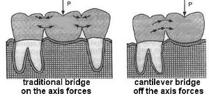 What is a Cantilever Dental Bridge?