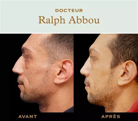 Rhinoplastie naturelle à Paris Dr Ralph ABBOU