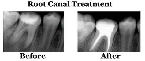 Single Sitting Root Canal Treatment Diamonds Dental Clinic