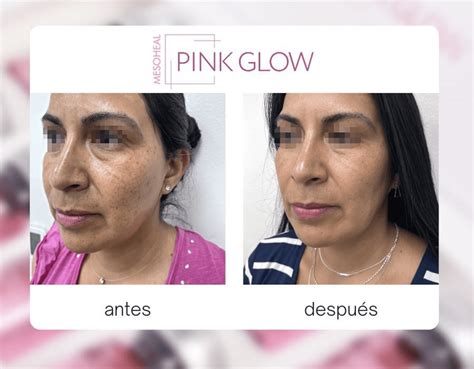 Vitaminas PINK GLOW Plasma Rico En Plaquetas Clinica Alma Medical