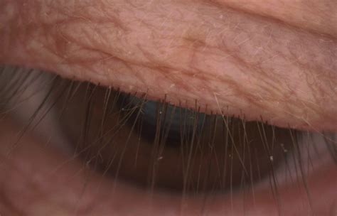 Staphylococcal Blepharitis