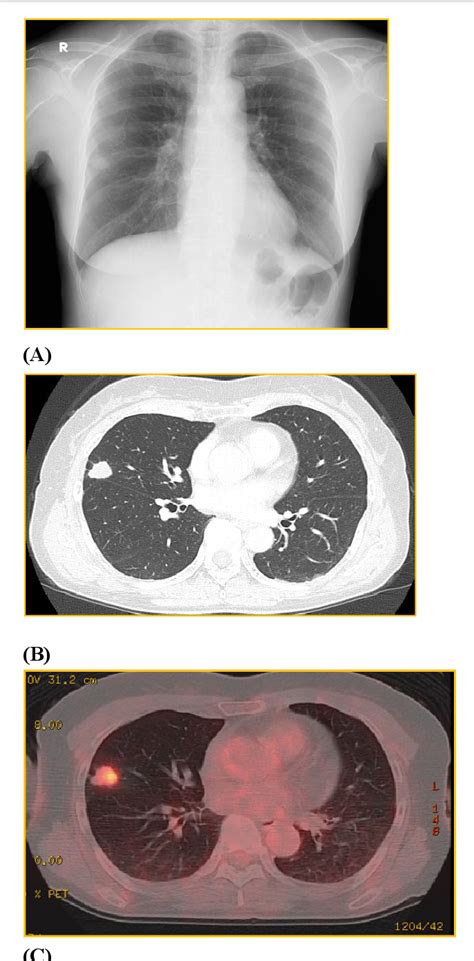 Figure 1 From A Case Of Pulmonary Epithelioid Hemangioendothelioma With