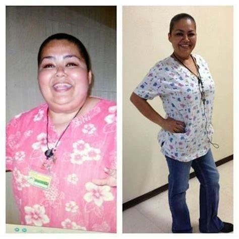 Patient 238213 Bariatric Surgery Before And After Photos Tijuana