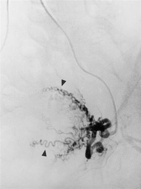 Uterine Artery Embolization For The Treatment Of Adenomyosis Clinical