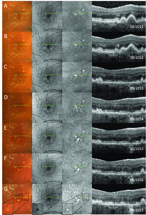 Typical Example For The Confluent Drusen Associated Structural