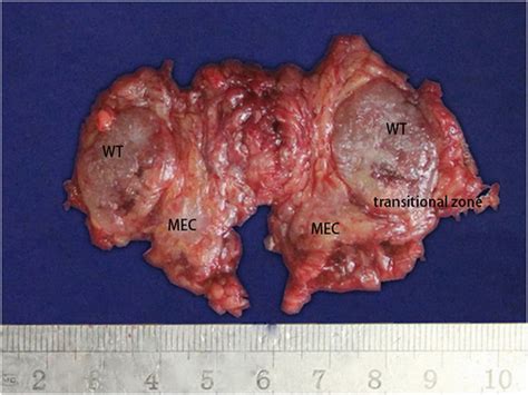 Gross Appearance Of The Tumor Derived From Case 5 Solid Sections