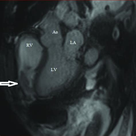 Cardiac Mri Image Of Thrombus Download Scientific Diagram