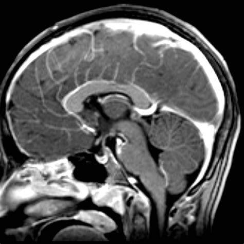 Polymicrogyria | Image | Radiopaedia.org