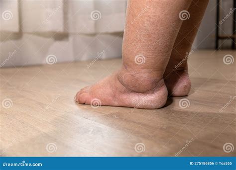 Edema Is Swelling Caused By Excess Fluid Trapped In Your Body S Tissues