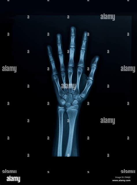 Radiografía De Mano Fotografía De Stock Alamy