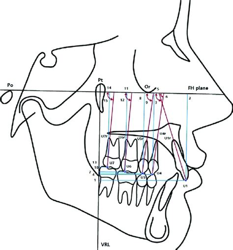 Dental Measurements Cephalometric Landmarks And Maxillary Dental