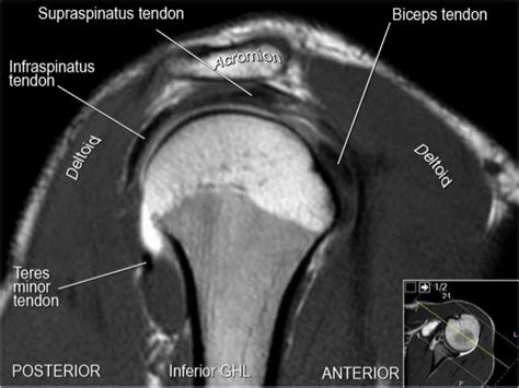 Mri Musculo Skeletal Section Mri Anatomy Of The Shoulder Sagittal View