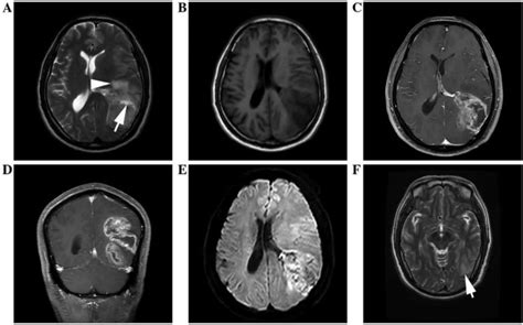 Ependymoma Causes Symptoms Diagnosis Treatment And Prognosis