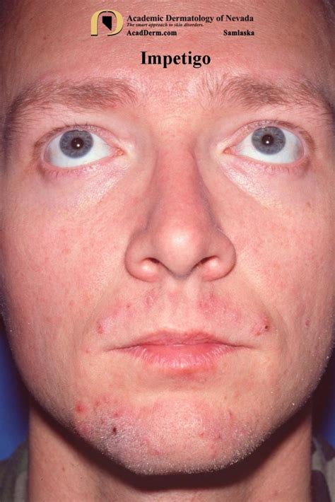 Impetigo Impetigo Contagiosa Academic Dermatology Of Nevada