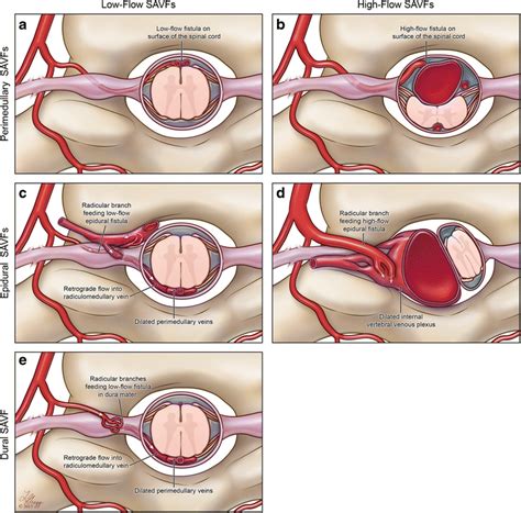 Classification Of Spinal Arteriovenous Fistulas According To Flow