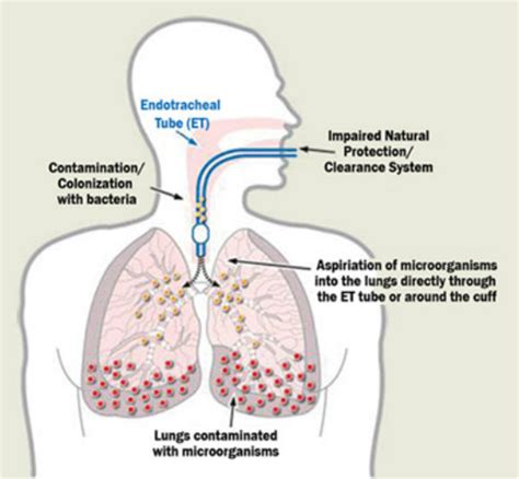 About Vap Learning Module Ventilator Assisted Pneumonia