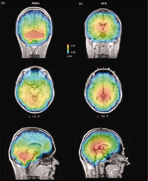 Exploding Head Syndrome