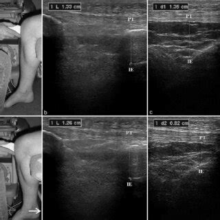 Ultrasonographic Evaluation Of Anterior Knee Translation During The