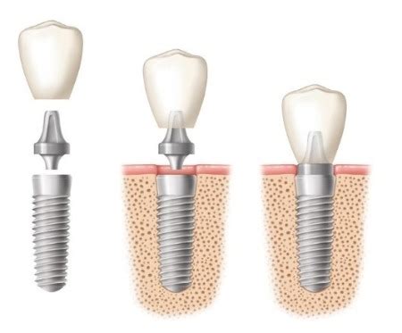 What Is The Procedure For Dental Implants ILAJAK Medical