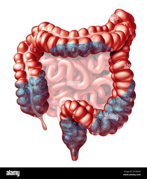 Verstopfung Anatomie Und Verstopfung Symptome Als Stuhl Stuhlgang