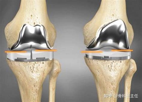 人工膝关节置换，什么时候该做手术，推迟手术会发生什么 知乎