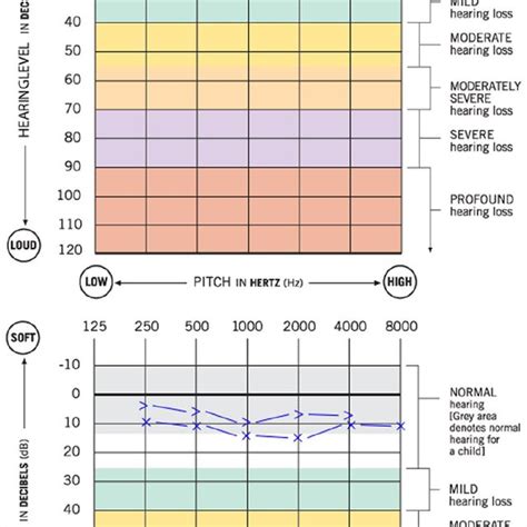 Pure Tone Audiogram Showing The Normal Hearing Level In This Patient Download Scientific Diagram