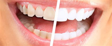 In Office Zoom Whitening Lpocut