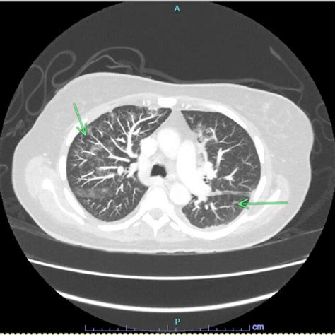 Patient S Axial Chest CT Scan With Contrast Where Two Green Arrows