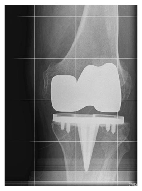 Anteroposterior Radiograph Of A Bilateral Tka Patient Implanted With