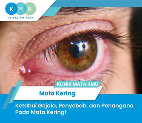 Mata Kering Gejala Penyebab Dan Penanganannya