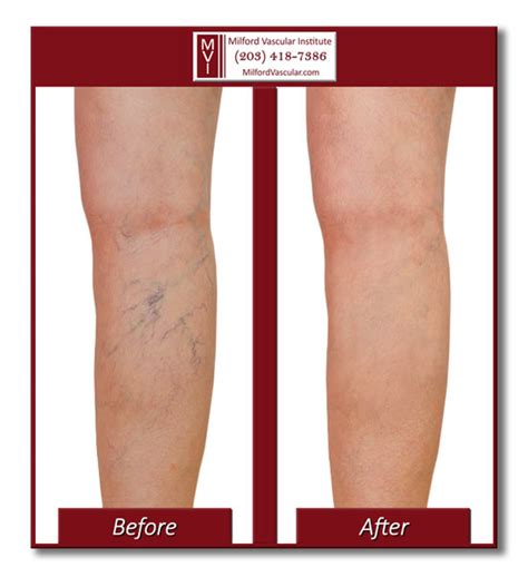 Spider Vein Removal New Haven Using Injection Sclerotherapy