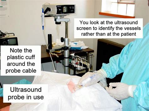 Clinical Notes Central Line Placement With Ultrasound Guidance A Step