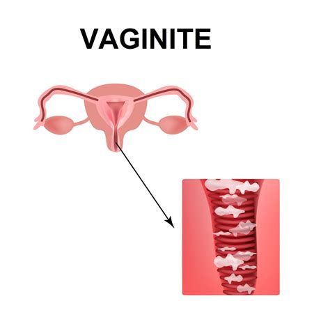 Vaginite Cause Quel Traitement Anti Irritation