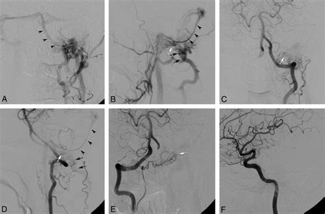 Frontal A And Lateral B Views Of An Angiogram Of The Left External Download Scientific