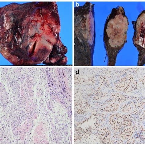 Surgical And Pathologic Findings A B Macroscopic Findings Of The