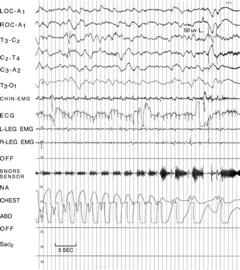 2 Obstructive Sleep Apnea Associated With Cerebral Hypoxemia Neupsy Key
