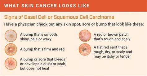 How To Detect Skin Cancer Roswell Park Comprehensive Cancer Center Buffalo Ny