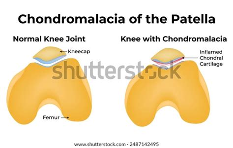 Chondromalacia Patella Science Design Vector Illustration Stock Vector